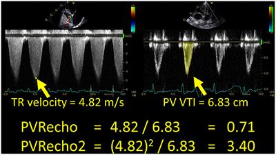 Pulmonary Vascular Resistance Estimated by Echocardiography in Dogs With Myxomatous Mitral Valve Disease and Pulmonary Hypertension Probability